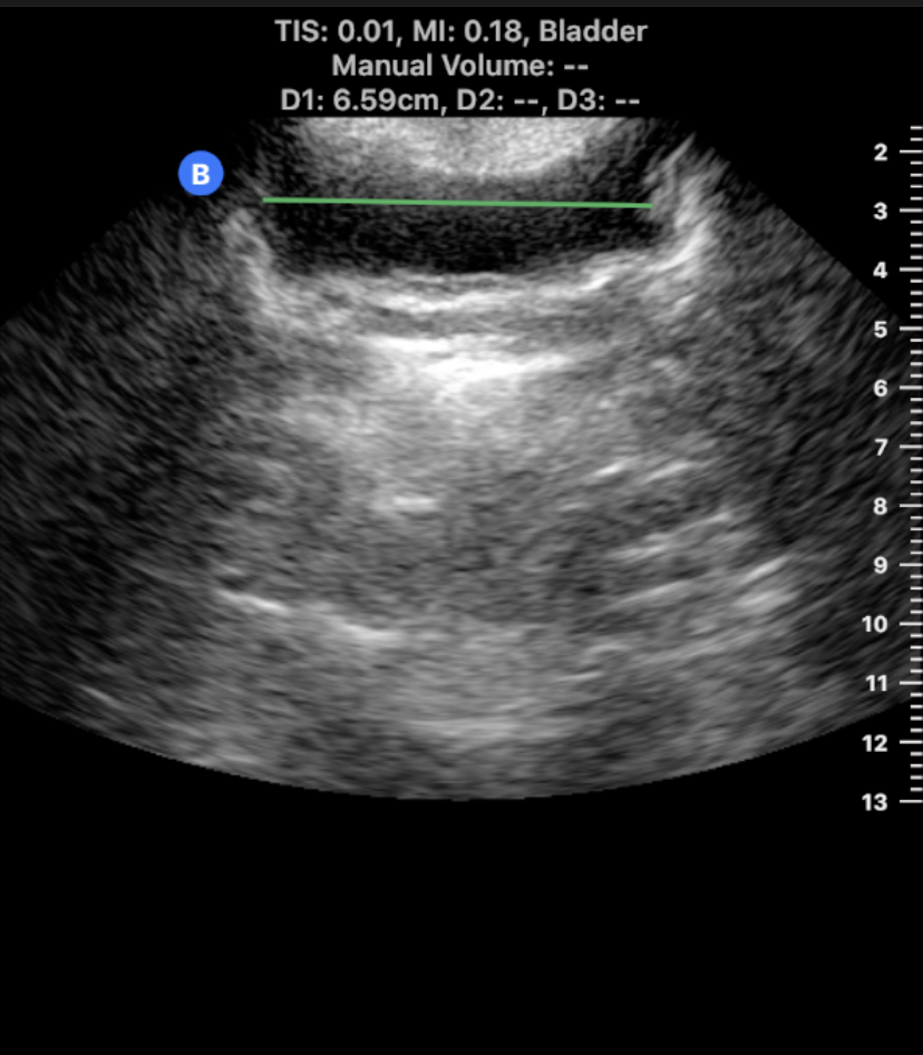 Bladder screenshot